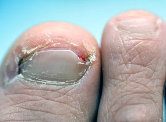 Tout savoir sur les ongles incarnés : causes, prévention et traitement