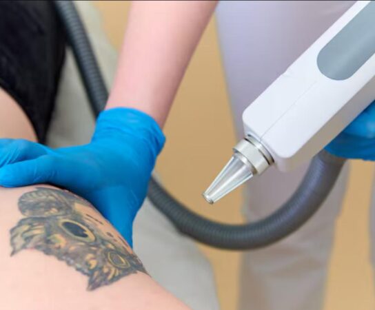 Détatouage au laser : douleur et efficacité