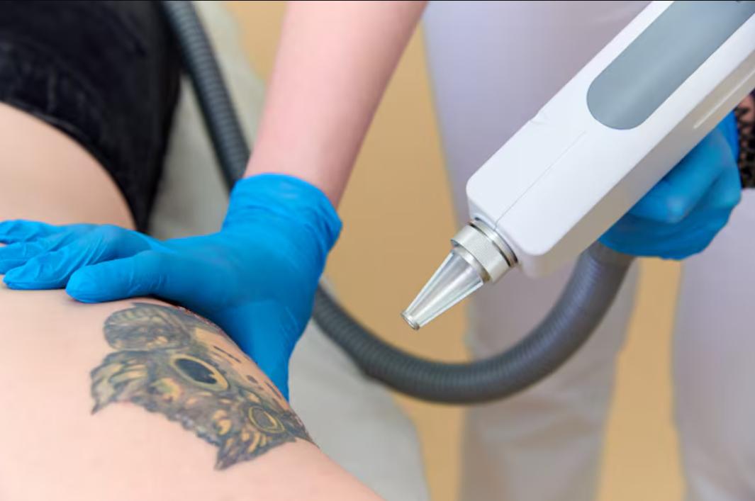Détatouage au laser : douleur et efficacité